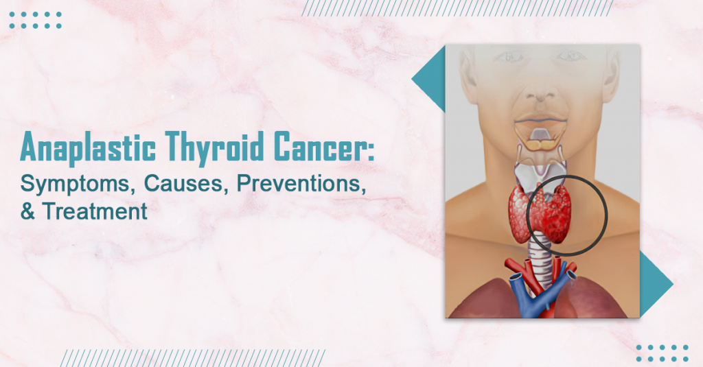 anaplastic-thyroid-cancer-symptoms-causes-preventions-treatment