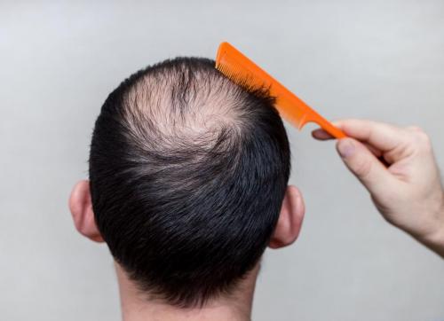 Alopecia Areata Treatment