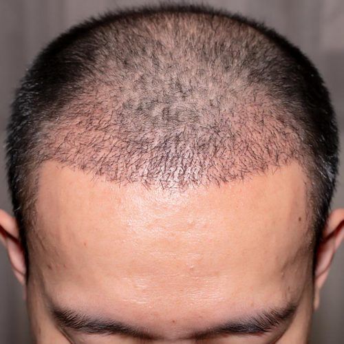 hair-transplantation-surgery