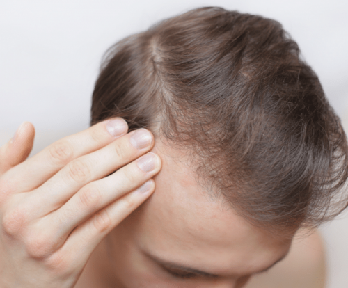 Can Hair Transplant Is The Final Solution Of Hair Loss