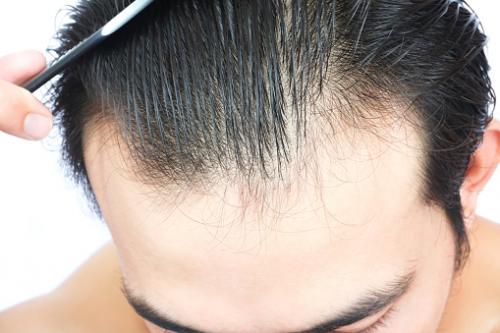 hair-transplantation