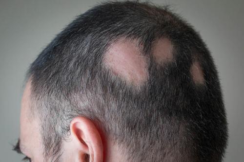 alopecia areata hair loss