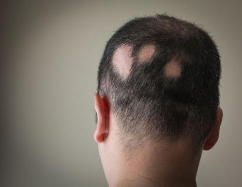 alopecia areata treatment in dubai