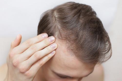 hair loss and alopecia