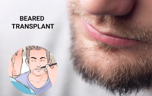 Beard Transplant in Mumbai