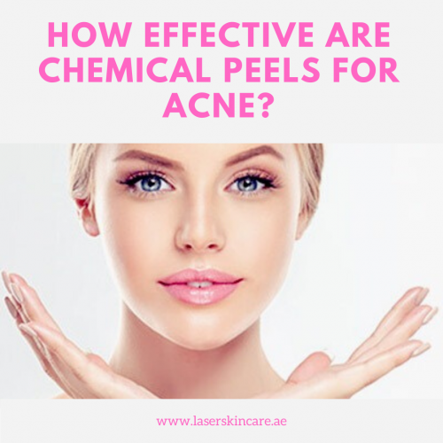 How Effective Are Chemical Peels For Acne