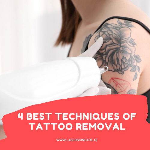 4 Best Techniques of Tattoo Removal