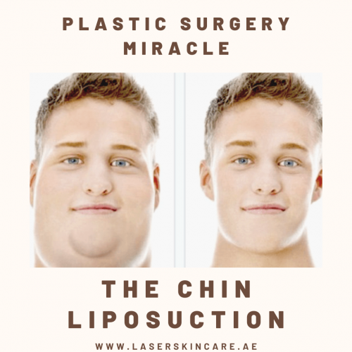 Plastic Surgery Miracle, the Chin Liposuction