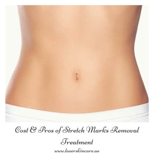 Cost & Pros of Stretch Marks Removal Treatment