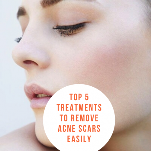 Top 5 Treatments to Remove Acne Scars Easily