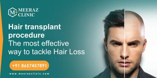 Know About Hair Transplant And How It Works?