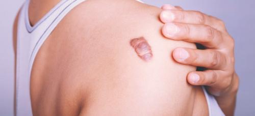 Keloid Treatment