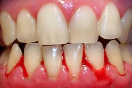 gum tissue removal