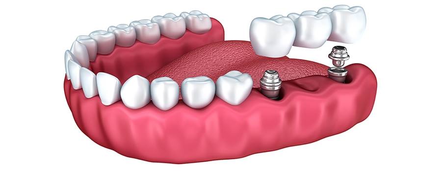 Dental Implants