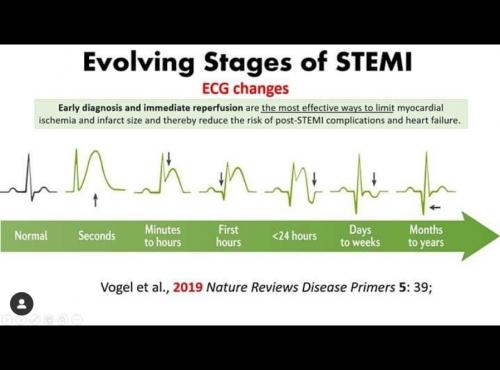 Evolving Stages of STEMI