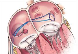 ATRIAL FIBRILLATION ABLATION