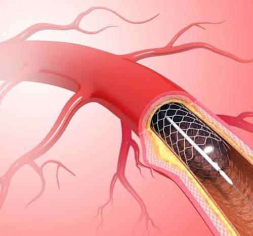 what is coronary angioplasty