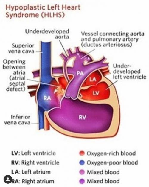 What is Hypoplastic left heart syndrome