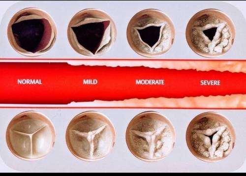 Why Aortic Valve stenosis occurs