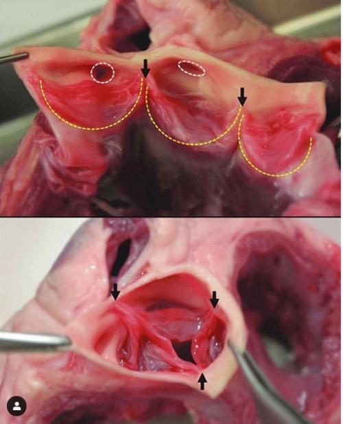 bisecte-aortic-valve