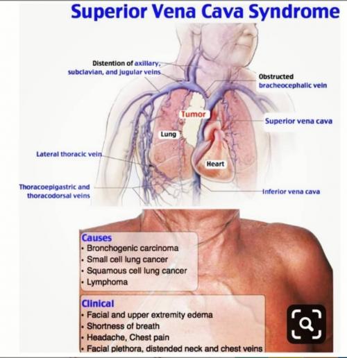 Superior vena cava syndrome