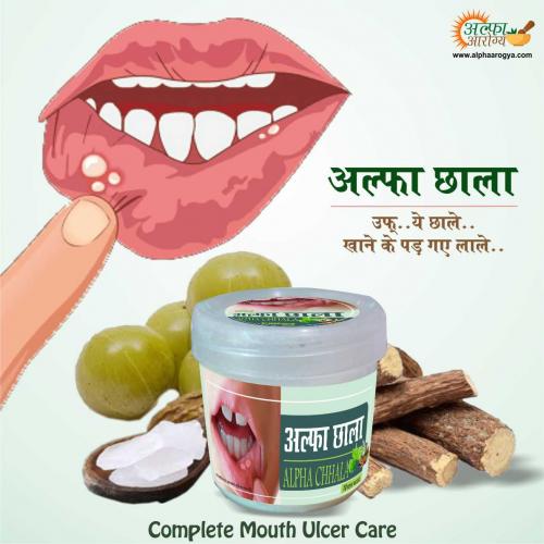 Ayurvedic Medicine for Mouth Ulcer-Remedy for Mouth Sores