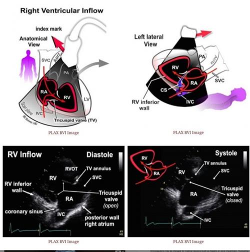 Parasternal right ventricular inflow