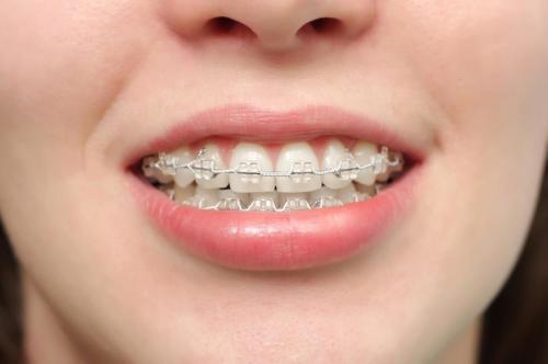 teeth-braces