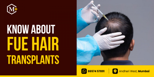 Important Facts that you don’t know about FUE hair transplant