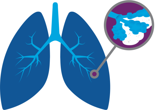 United States Idiopathic Pulmonary Fibrosis Treatment Market3