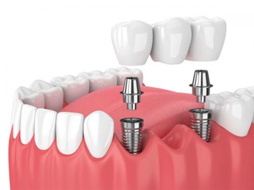 Dental-crown