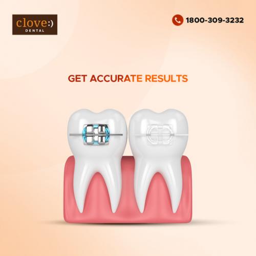 Teeth Braces - Straighten Your Teeth With Clove Dental