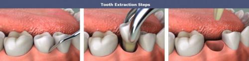 Tooth Implant Toronto ON