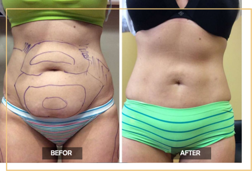 abdomen-liposuction-surgery-in-Delhi