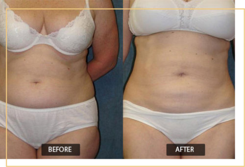 abdomen liposuction in Delhi