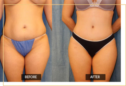 belly fat removal in Delhi