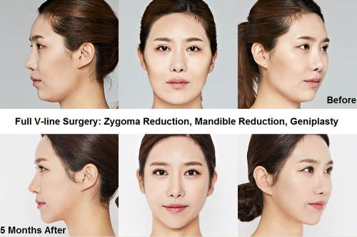 11-face-contouring-seoul-guide-medical-before-and-after