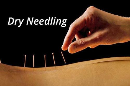 Enhance Healing with Expert Dry Needling in Dubai | Pure Chiropractic