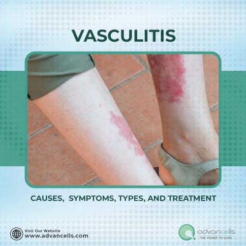 Vasculitis_Squre