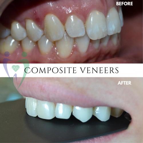 Composite Veneers in Dubai