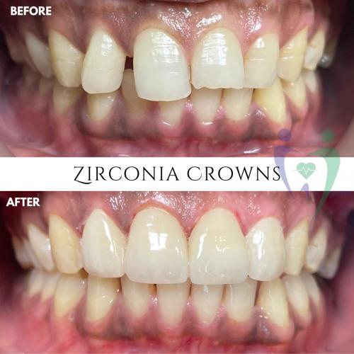 Zirconia Crown in Dubai