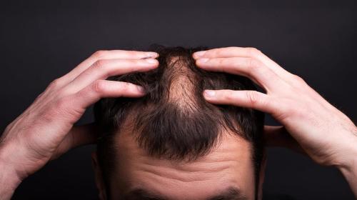 Hair transplant in Islamabad F7