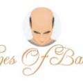 stages of balding
